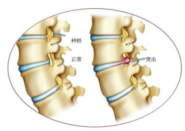 小分子肽能治疗腰椎间盘突出吗.png