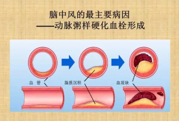 肽能治疗中风后遗症吗.png