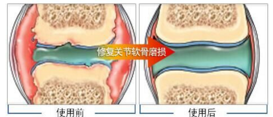 胶原蛋白对修复关节有用吗.png