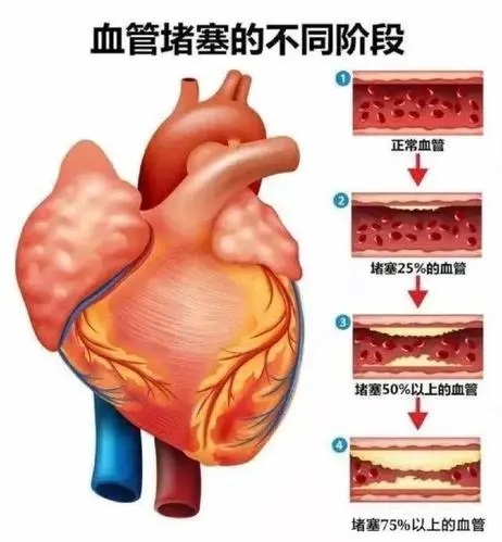 心血管堵塞症状.jpg