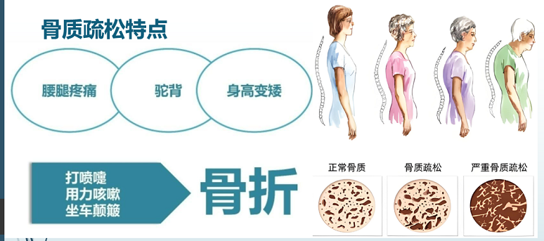 骨质疏松的特点.png